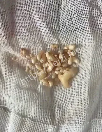 多生牙拔除经历